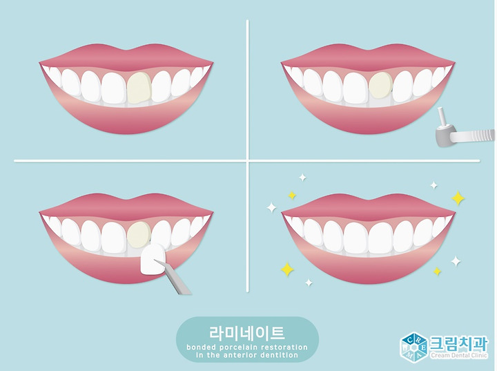 앞니 라미네이트 / 연예인 치아성형 11