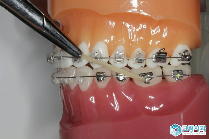 치아교정 시 고무줄로 인한 통증, 고무줄의 역할은?