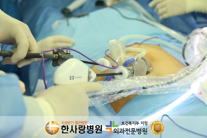 담석증의 우측 상배 명치가 아픈 증상의 원인 치료 담낭 담석 제거 - a21