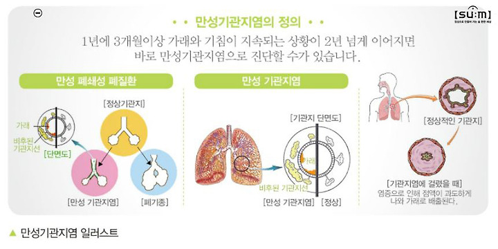 9개월 코감기로 시작한 기관지염 증상 일주일만에 극복(아기 가래 기침)